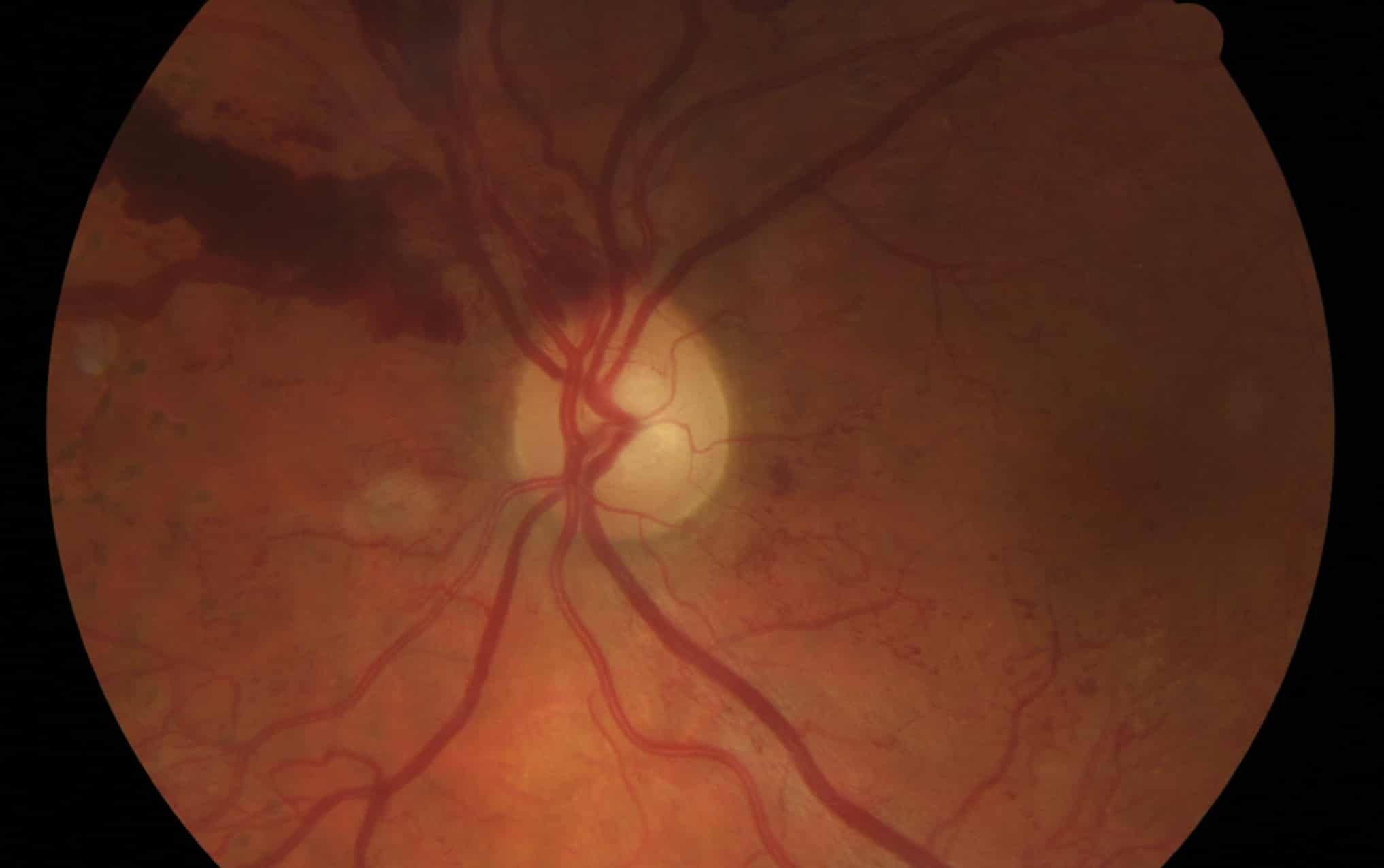 diabetic eye disease KeepSight