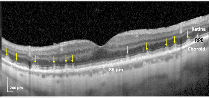 Damaged retina of study participant with a previous heart attack. Image: Mount Sinai Health System.
