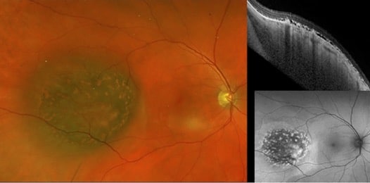 Choroidal Nevus With Lipofuscin