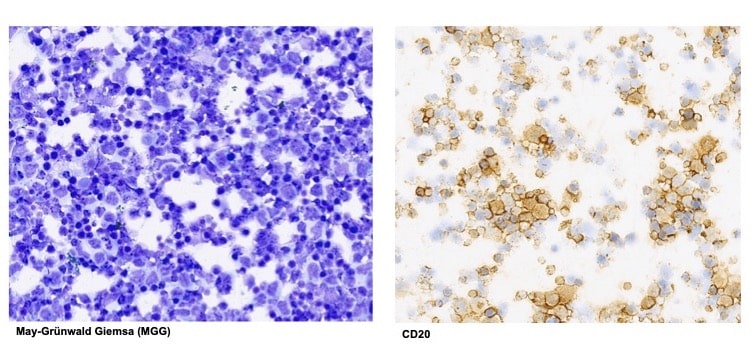 Intraocular lymphomas Prof Sarah Coupland