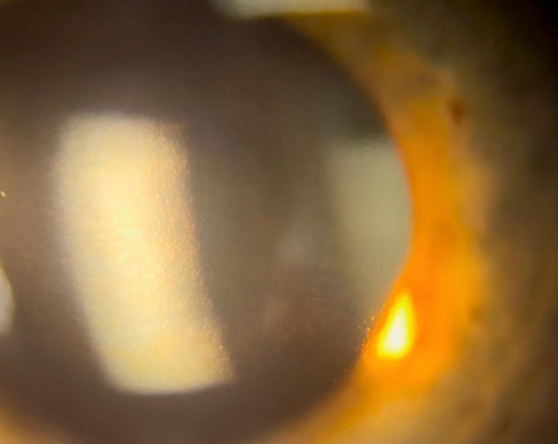 Co-managing corneal disease in patients requiring cataract surgery