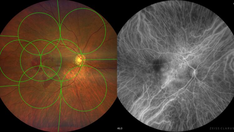 The CLARUS 700 can capture widefield, early-phase high-resolution images, including simultaneous FA and ICGA. Image: ZEISS
