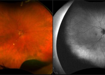 Optos colour ultra-widefield fundus photograph (left) and autofluorescence (right) with the posterior edge of a ciliary body melanoma visible in the inferonasal periphery. Image: Dr Lindsay McGrath.
